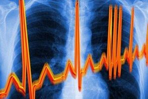 Arythmie cardiaque pour l'ostéochondrose