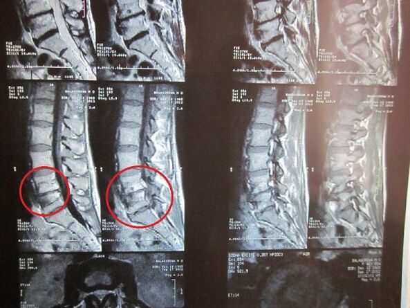 Diagnostic d'ostéochondose cervical