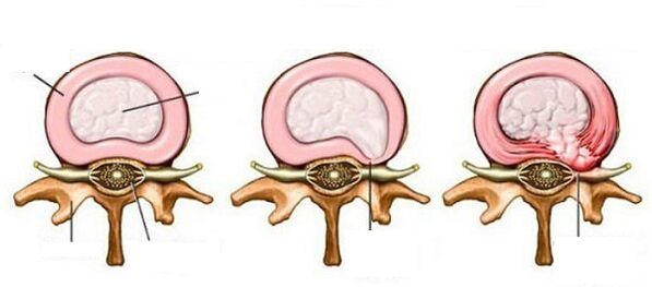 Hernie intervertébrale avec ostéochondrose cervicale
