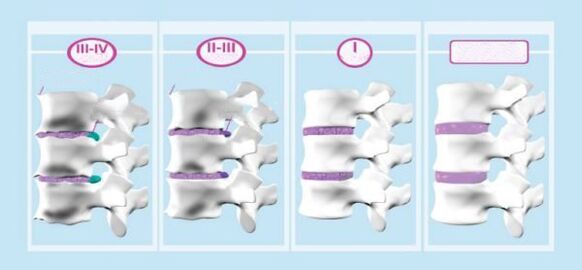 Étapes de l'ostéochondose cervicale
